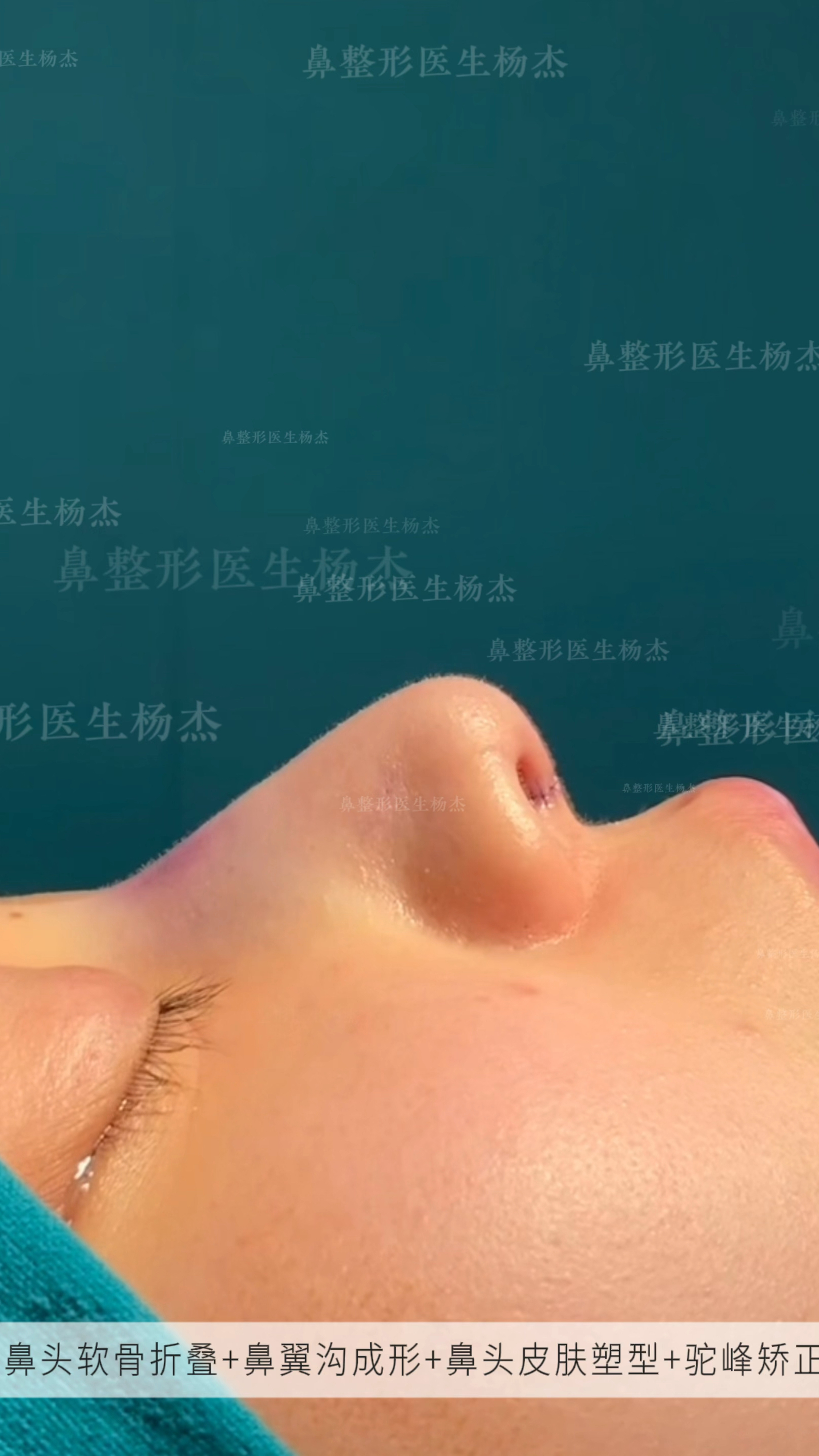 鼻头软骨折叠 鼻翼沟成型 鼻头皮肤塑形 驼峰矫正-度小视