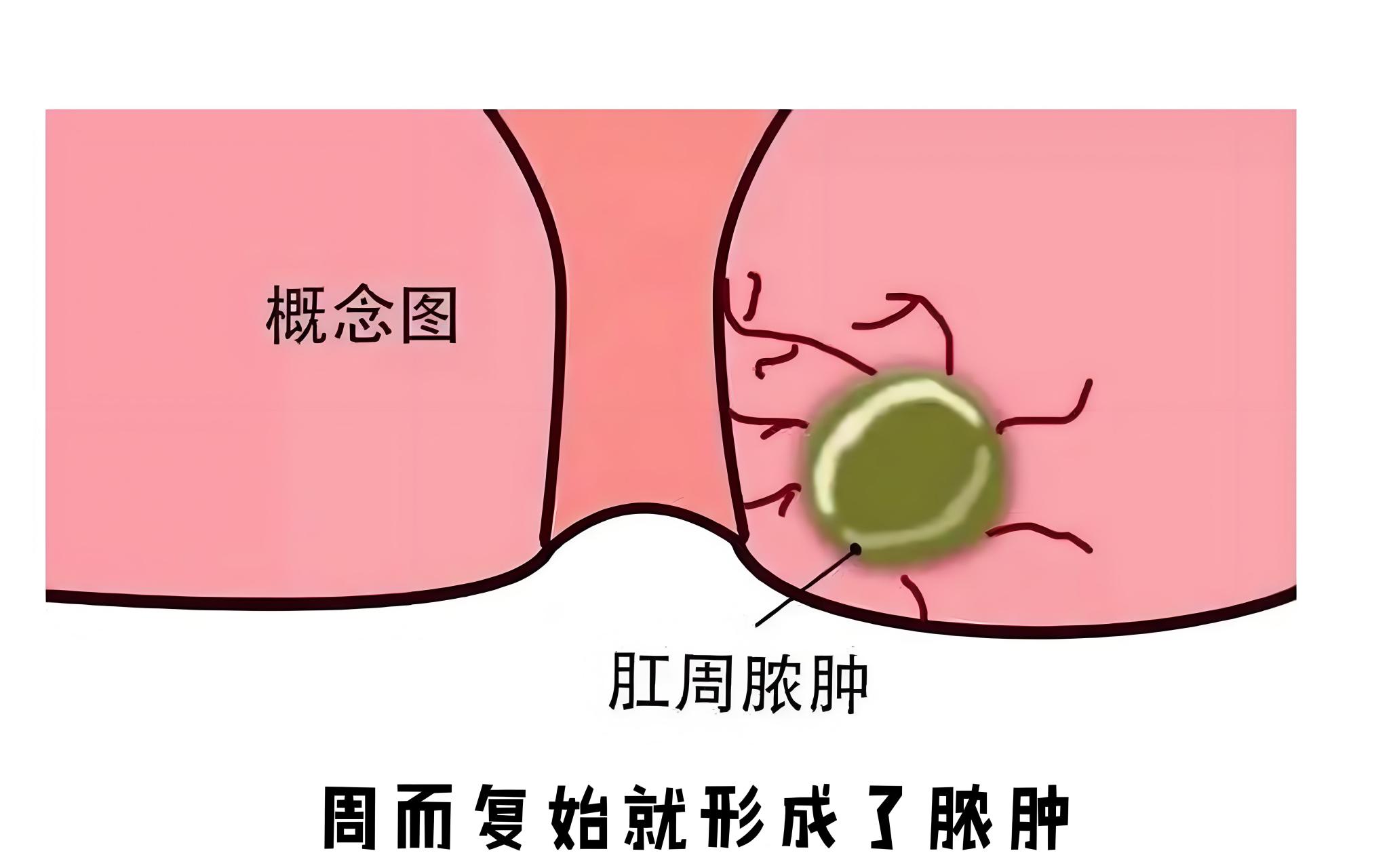 肛周化脓性汗腺炎图片