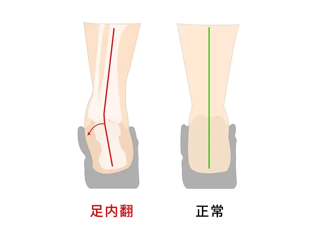 足旋前位图片