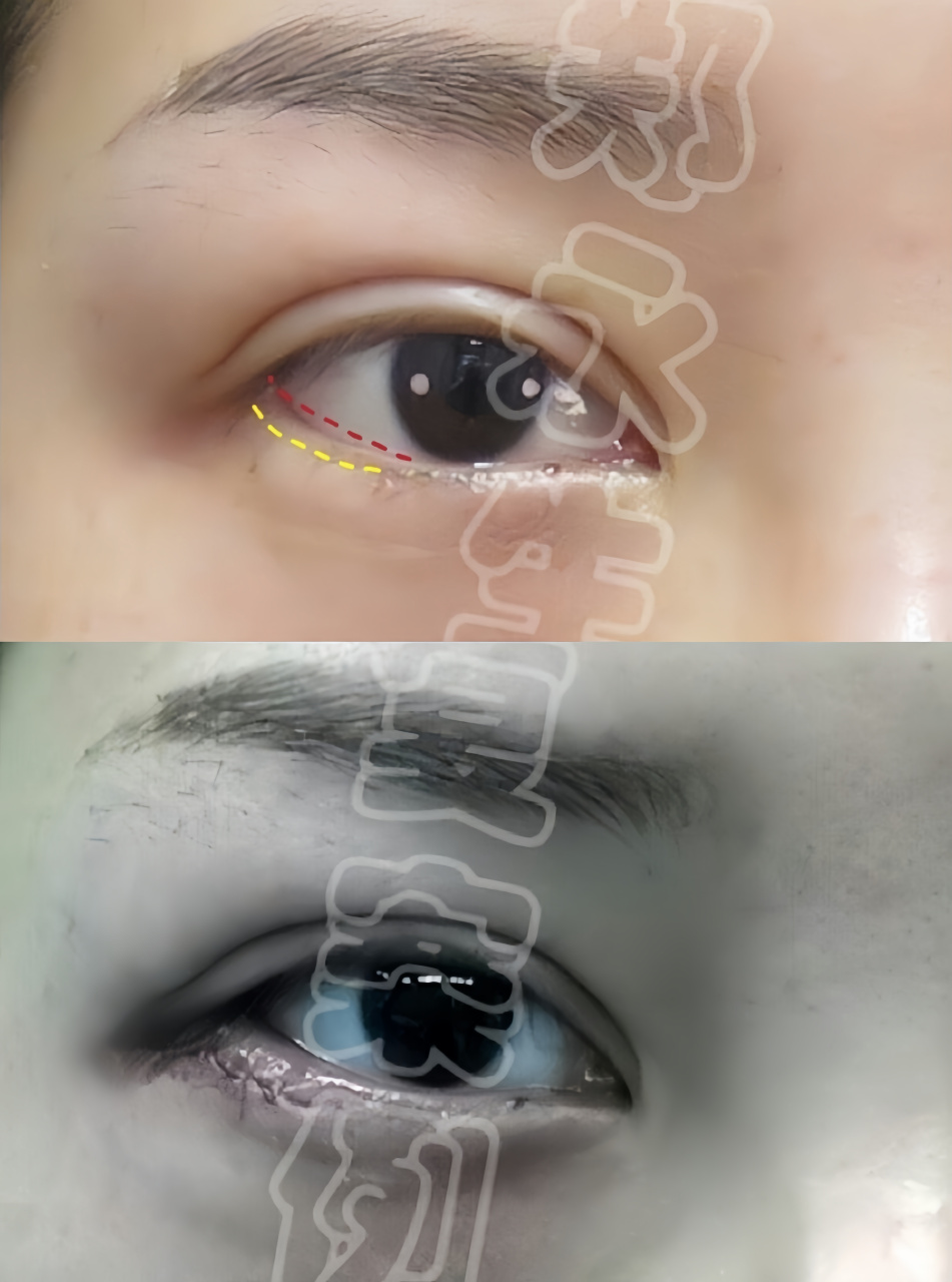 修复主要看这2种情况  1,缺损不严重: 我们可以通过外眦眼轮匝肌向上