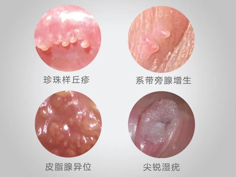 龟头尖锐湿疣的典型症状包括