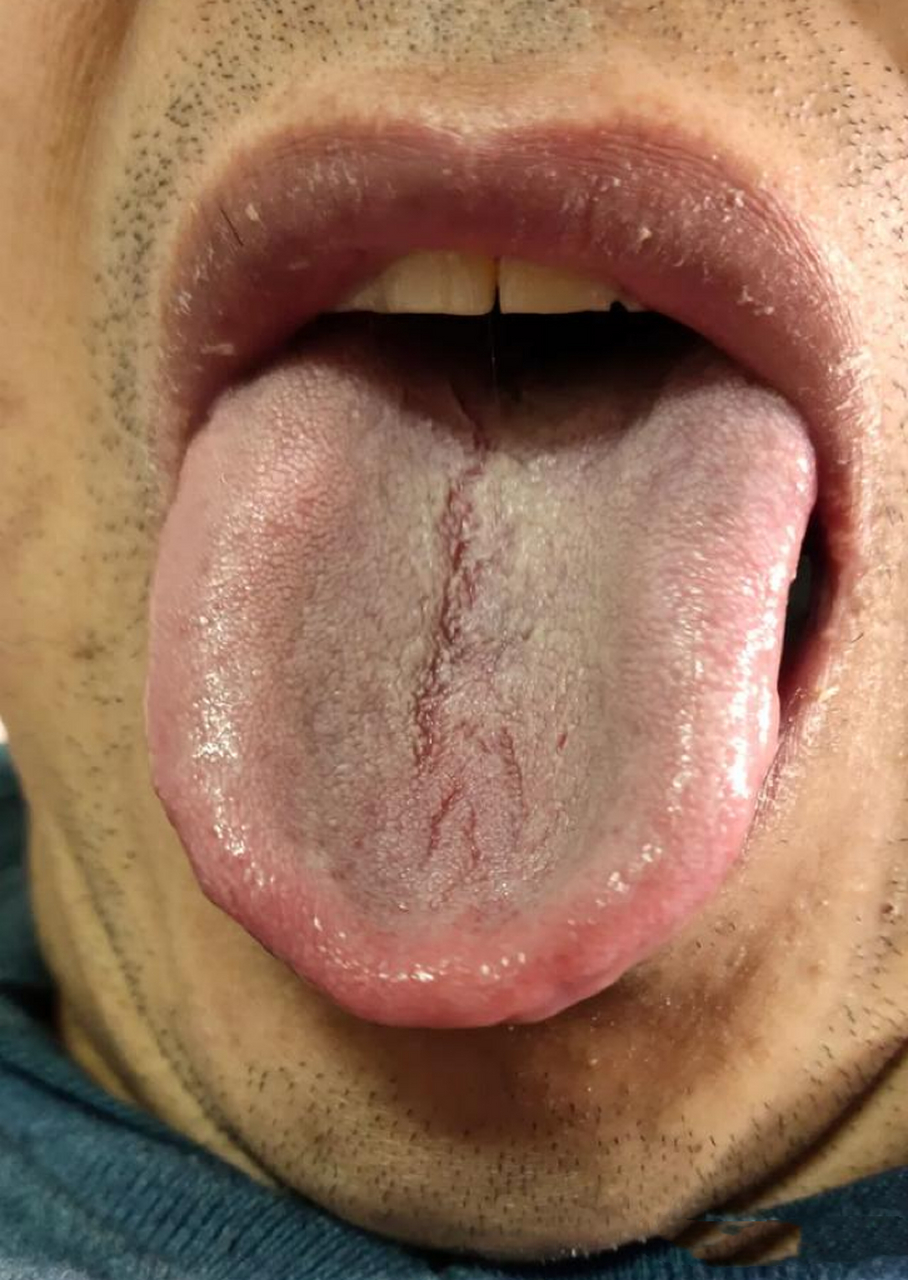 舌中裂纹,苔厚腻,吃再多的健脾祛湿药也没用!中医看病讲究整体!