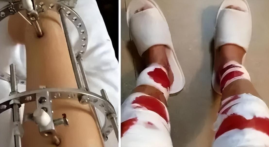 回顾北京小伙李亚诺花16万断骨增高72厘米如今怎样