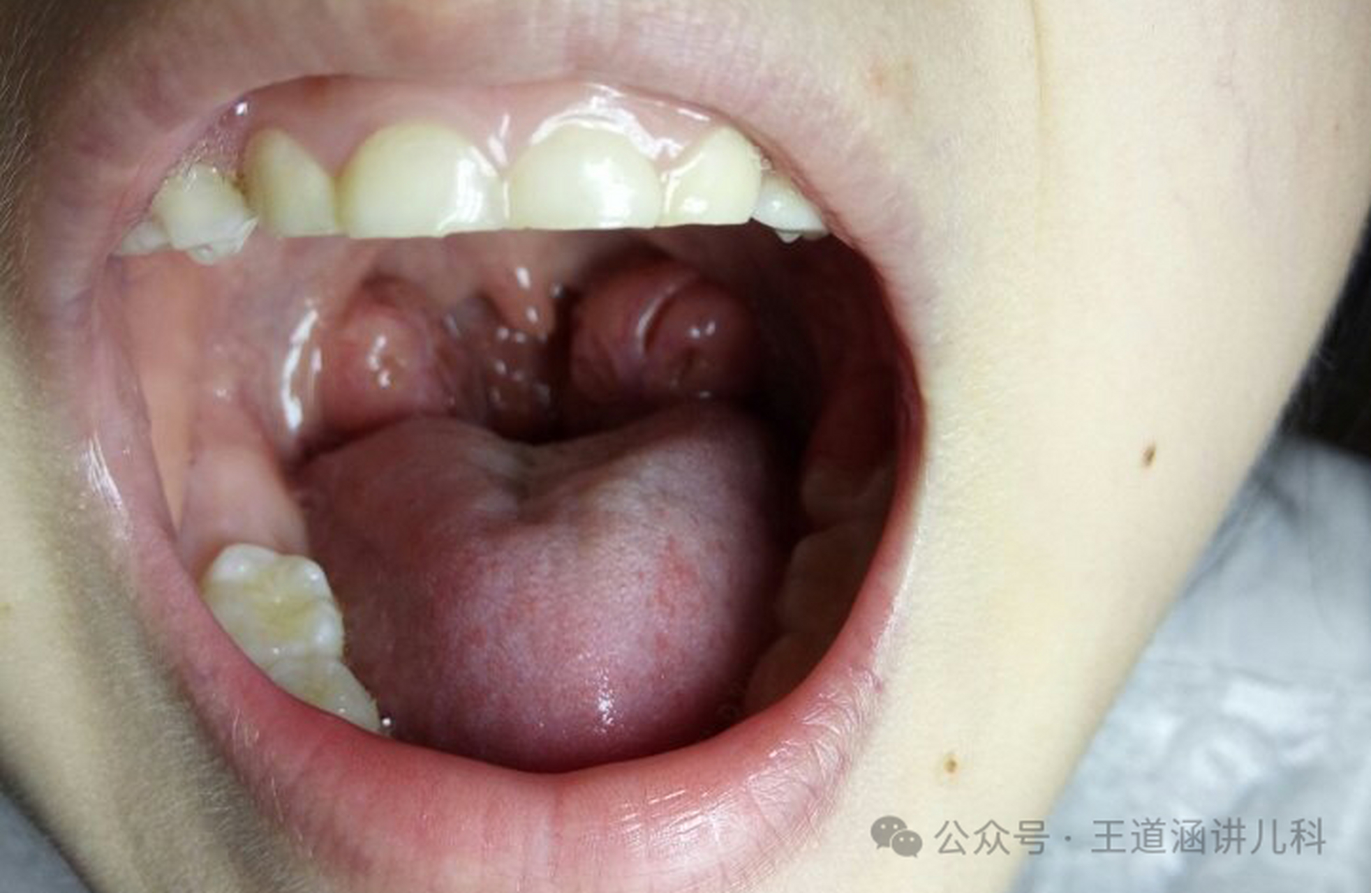 孩子腺样体肥大危害大,影响缺氧,听力甚至面容!2-7岁是关键期.