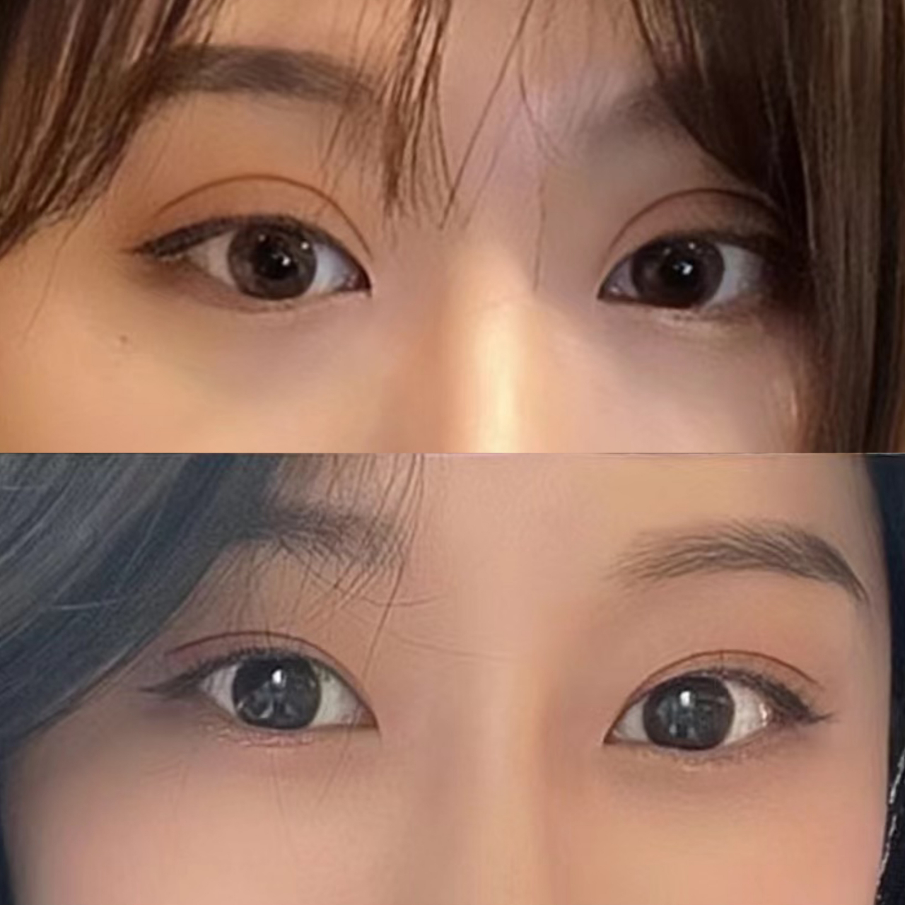 修复竟然变成妈生眼  该求美者修复前跟风做的欧式双眼皮,宽度10mm,假