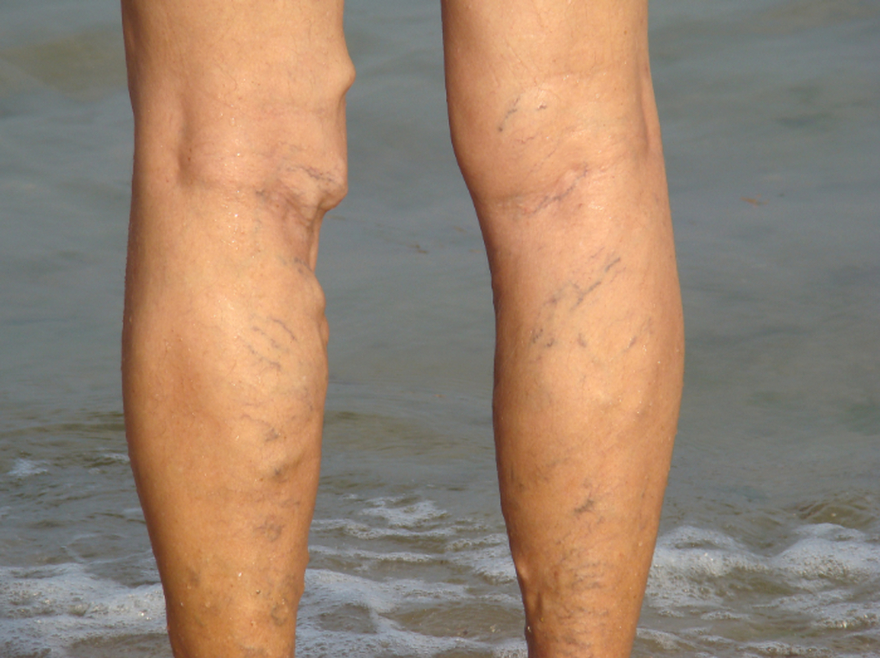 静脉曲张的"蚯蚓腿"到底是怎么回事?