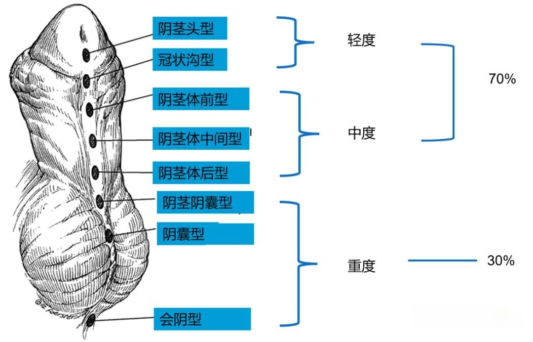 尿道下裂分型的图片图片