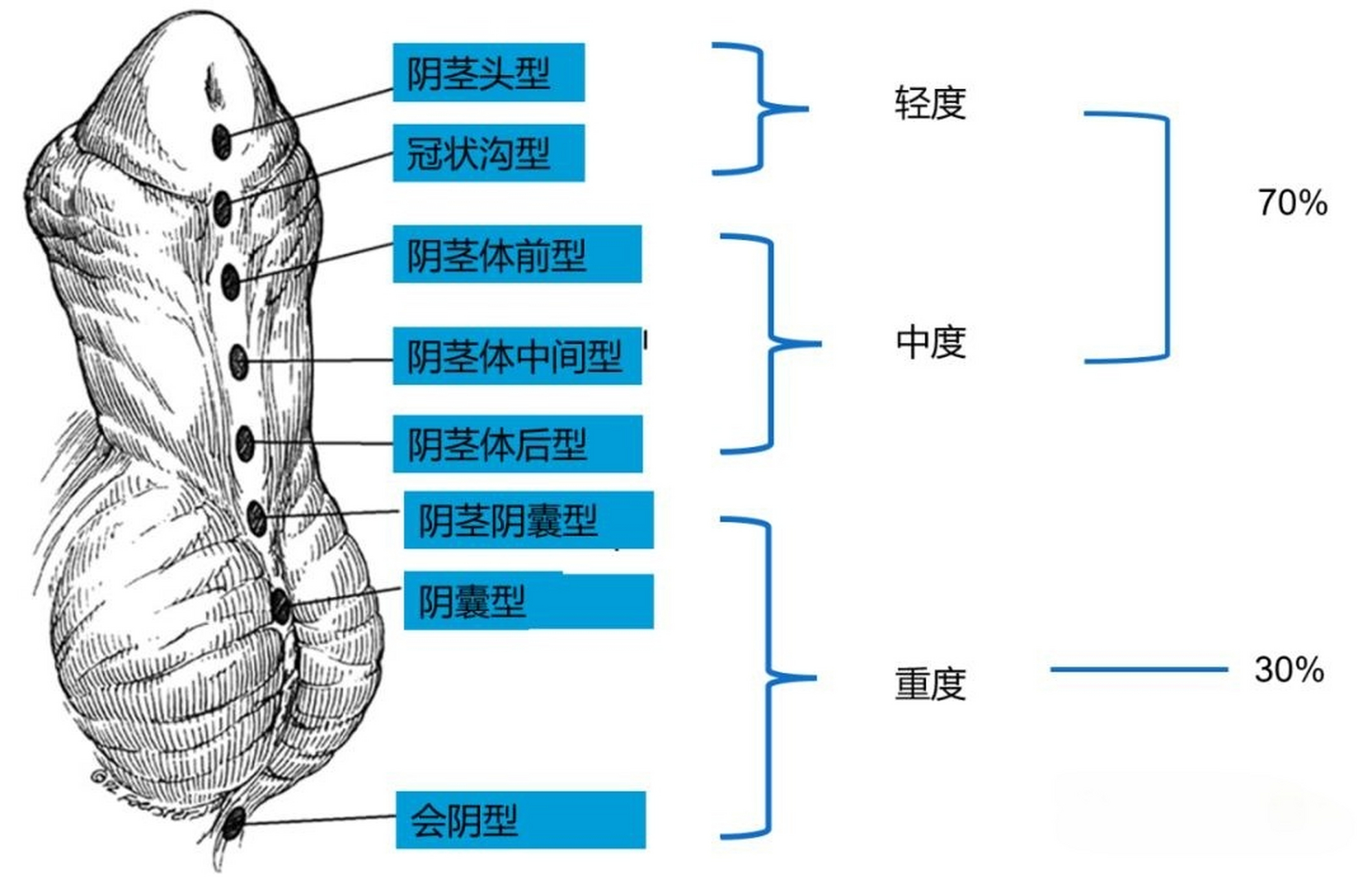 尿道下裂图片类型图片