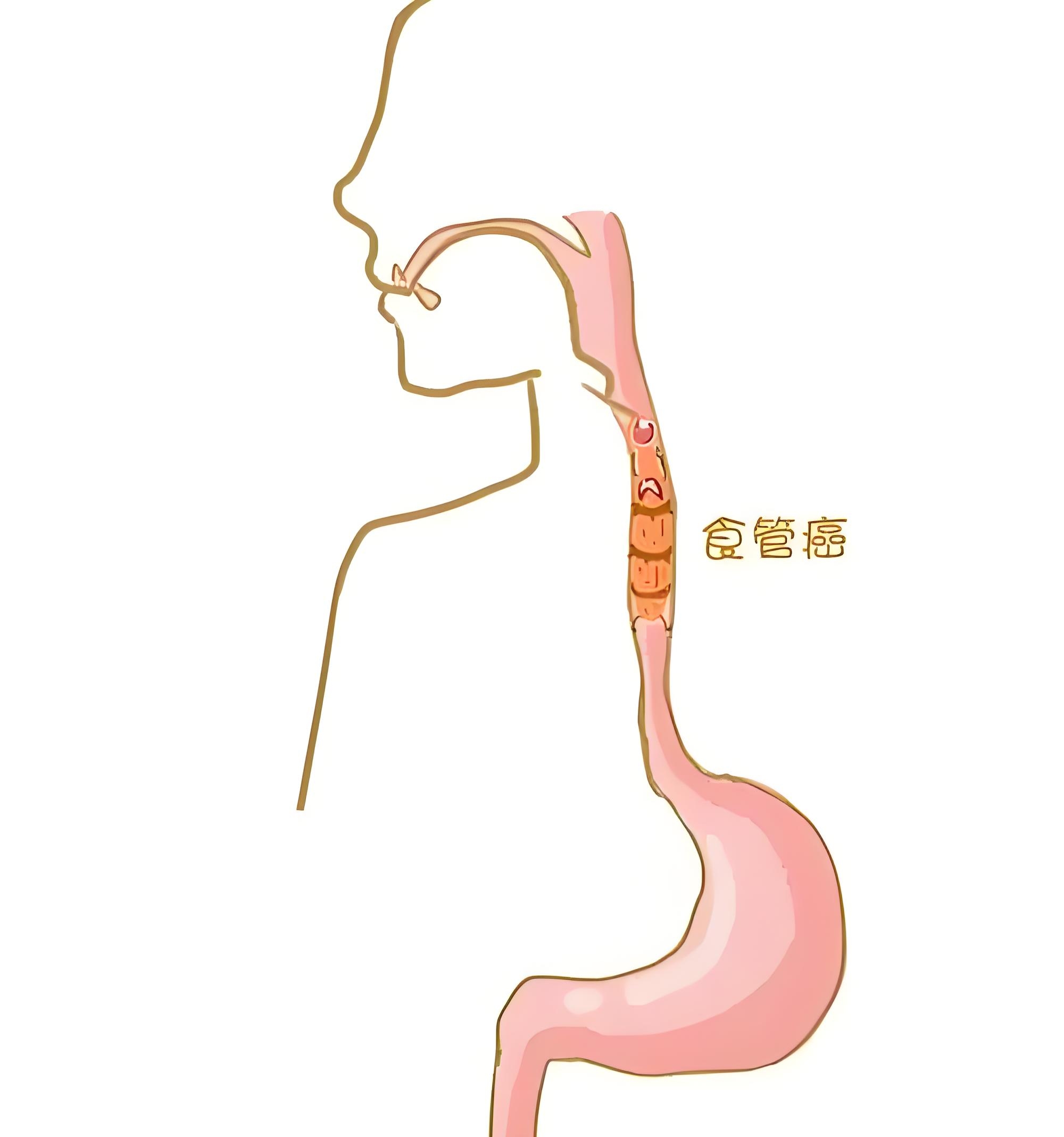 食道癌的8个症状图图片