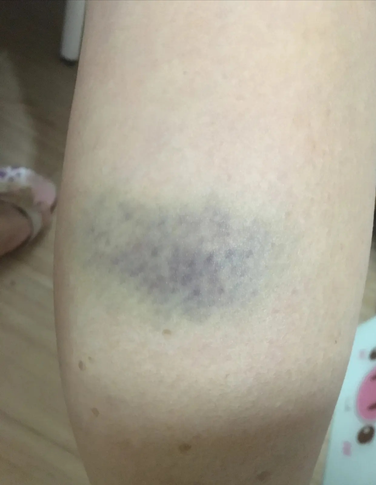 万能的头条,我想问一下,我小腿和大腿上,经常青一块紫一块的,有於青