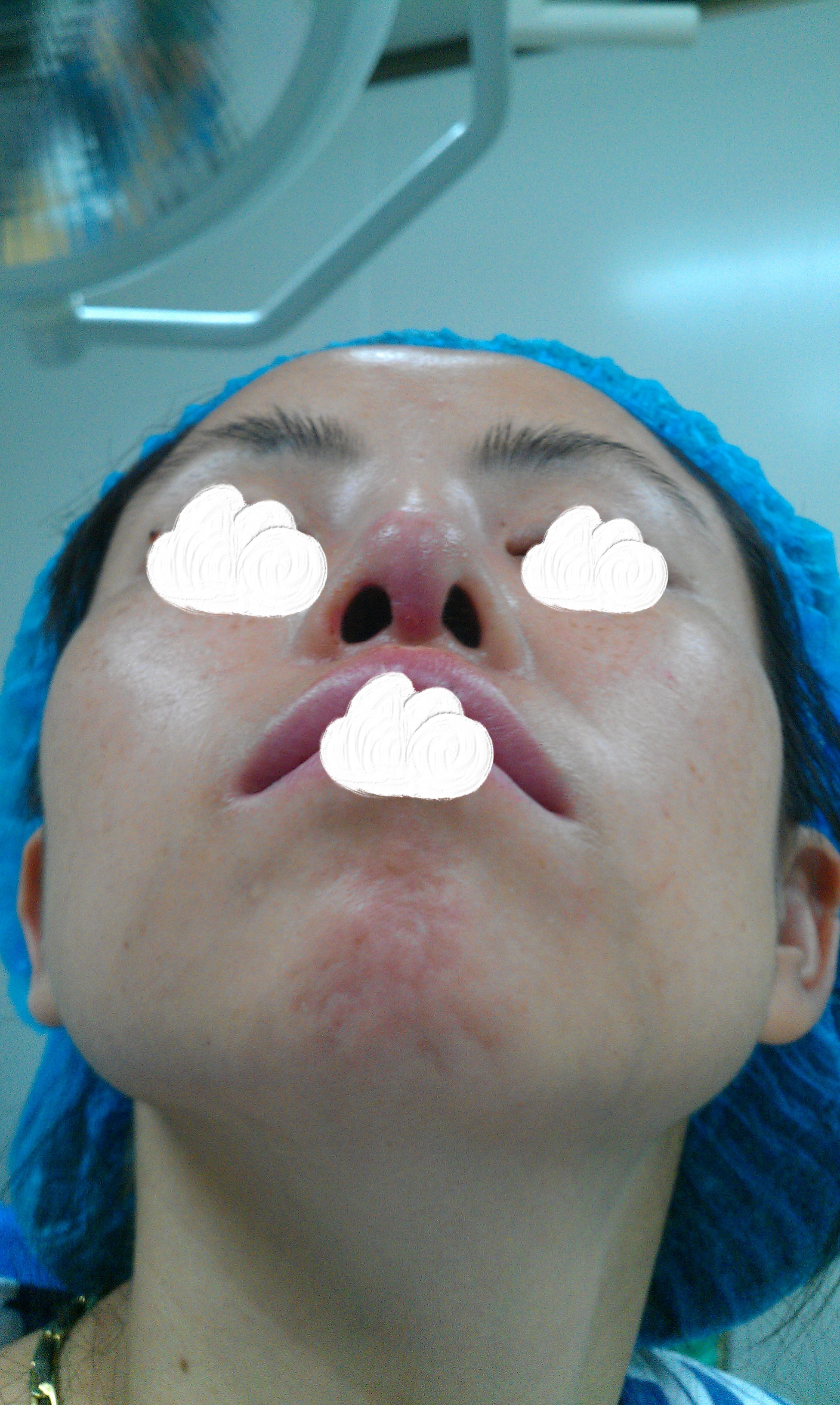 鼻假体歪斜,鼻尖发红,有钱修复,但是累了,年纪大了,修不动了.