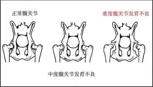 警惕儿童髋部的"头号杀手"
