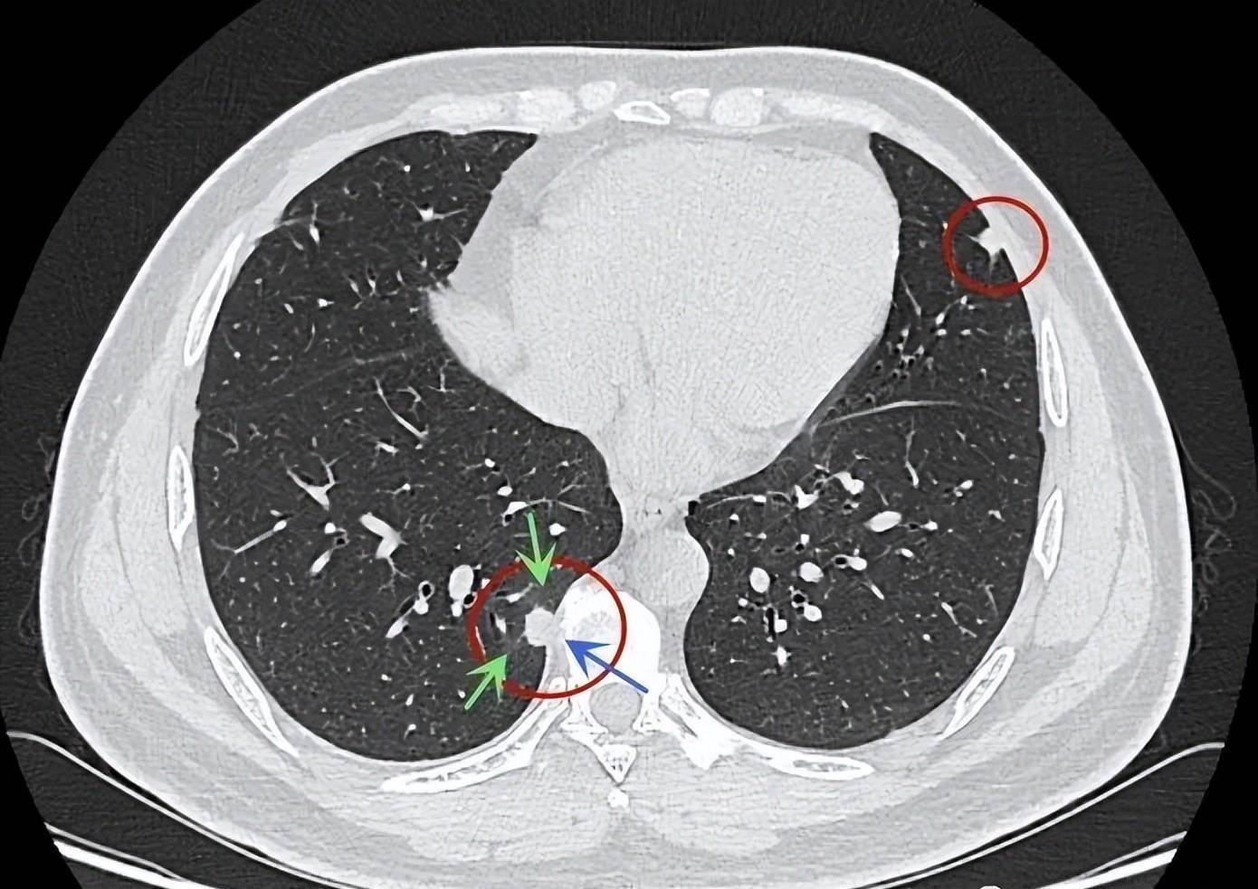 肺结节和肺癌什么关系?医生说出实话