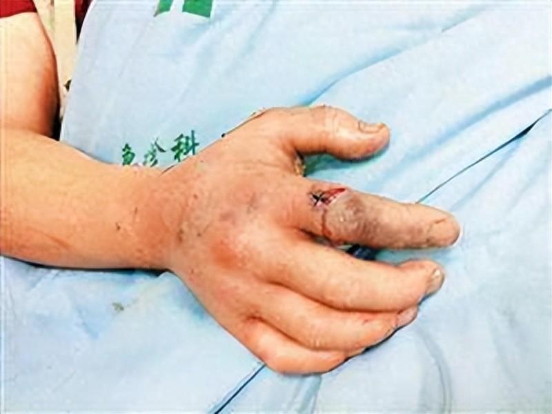 18年陕西女孩养蛇当宠物不慎被咬伤抢救时宁死不说是什么蛇