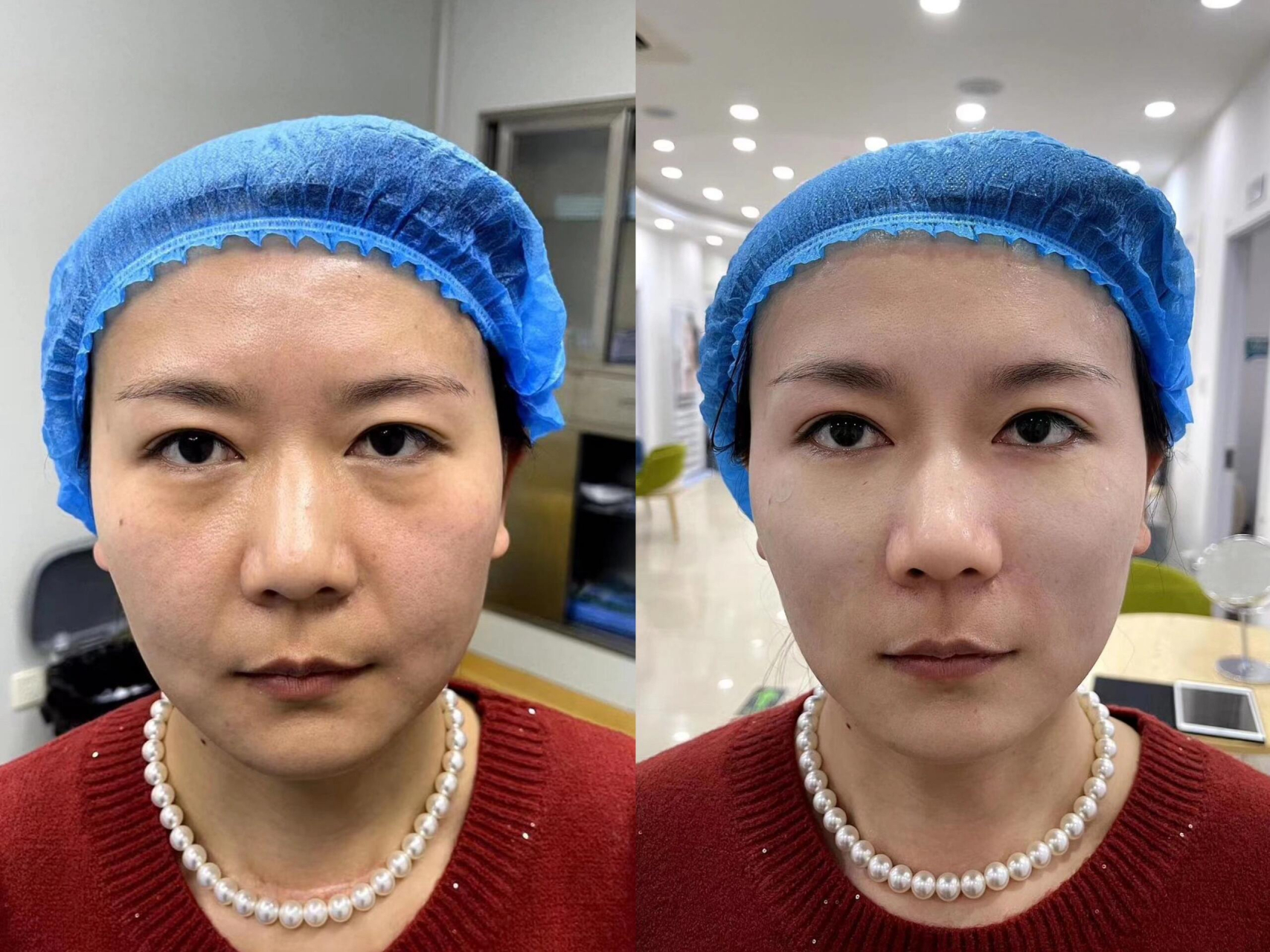 46岁女士做完无痕筋膜提升即刻效果对比  刚刚做完的一台筋膜提升  术