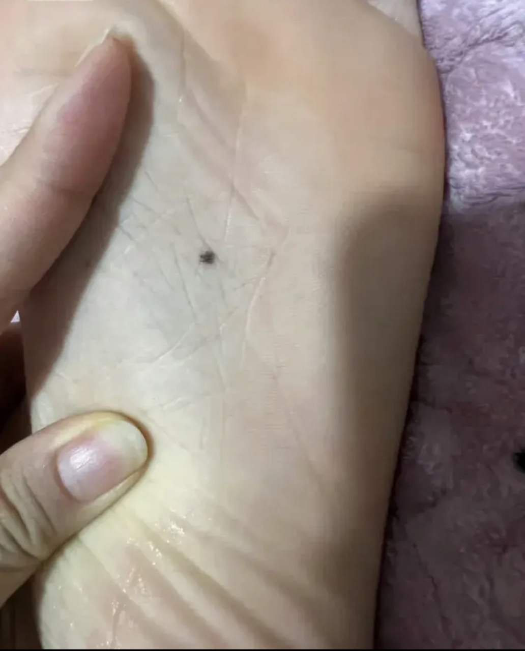 我问同事,她说我傻,我算捡到大宝贝了,脚底下长痣的人是所谓的"封侯带