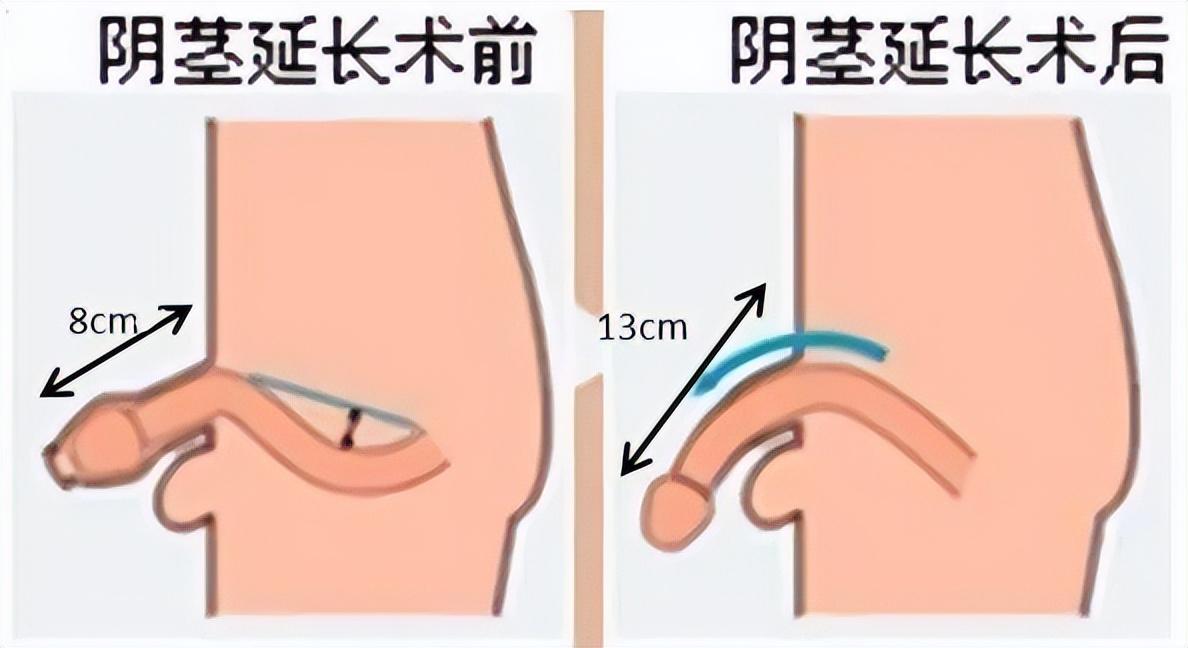 2016年大二学生切包皮13天后竟死亡调查后发现医院黑幕