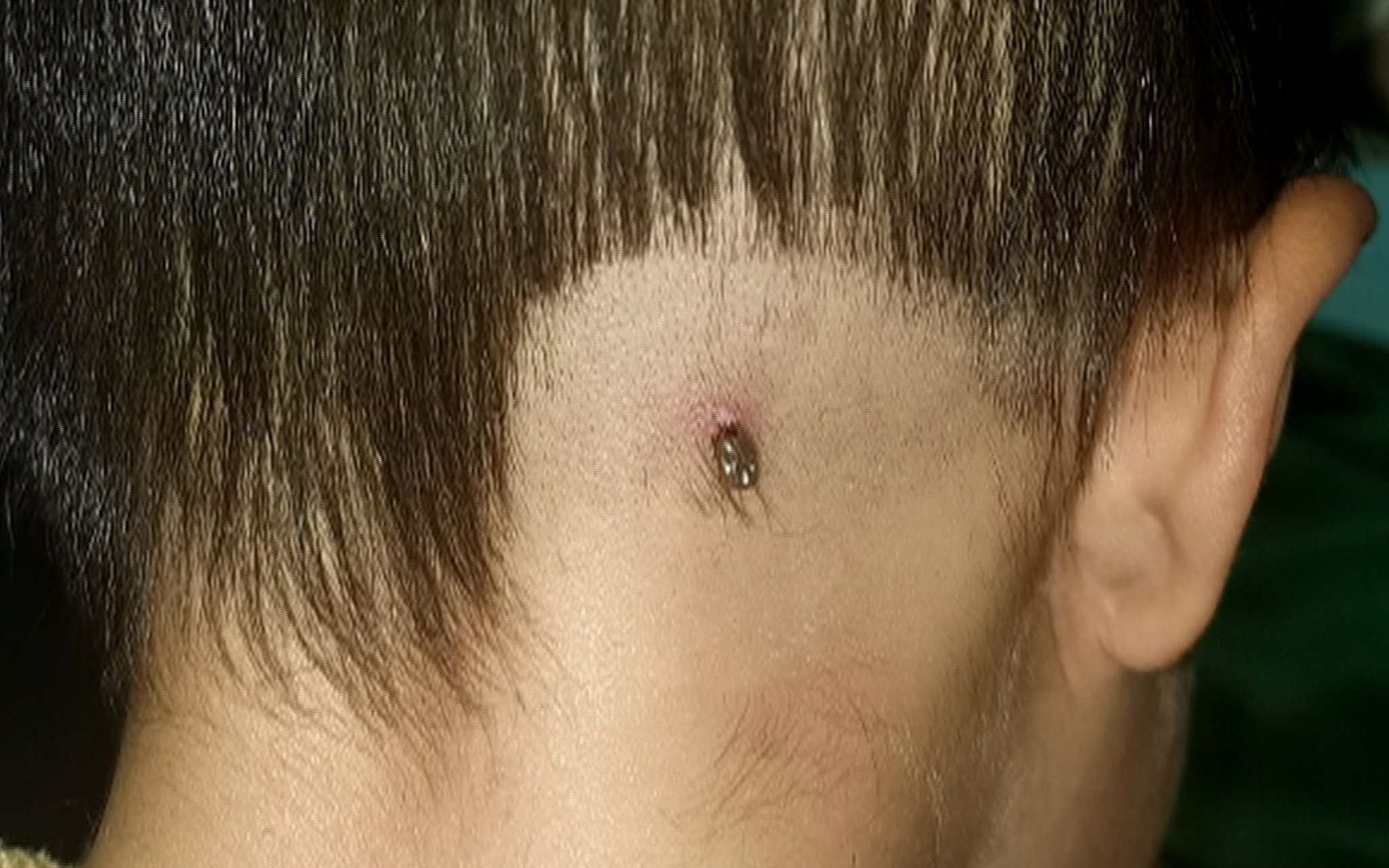 近期多人受伤,这个虫子进入了活跃期,千万别硬拔!
