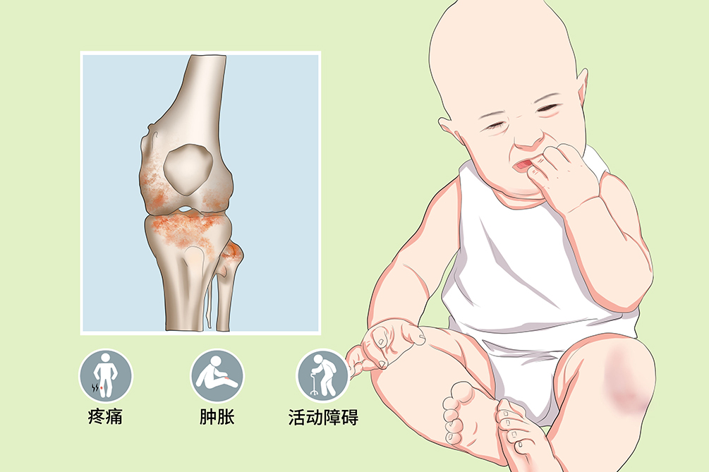 骨肿瘤卡通图片