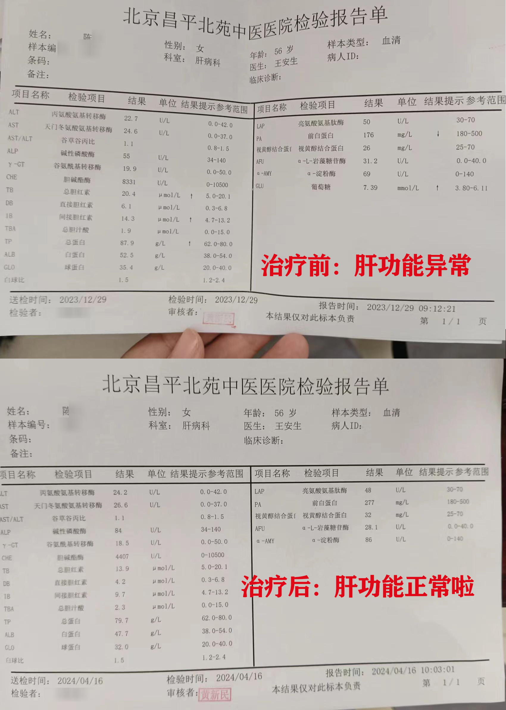 肝功能化验单肝硬化报告肝硬化检查肝硬化化验单图片肝硬化病例肝硬化