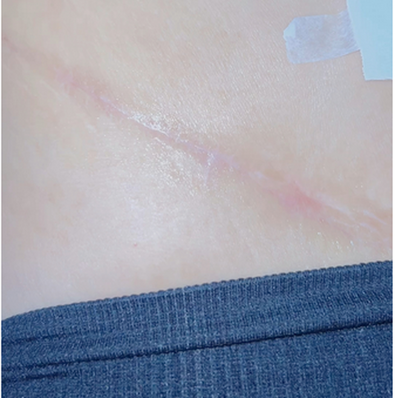 想做腹壁成形,但害怕刀口大疤痕大怎么办?