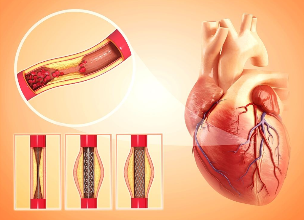 心脏支架手术是利大还是弊大?科普真相