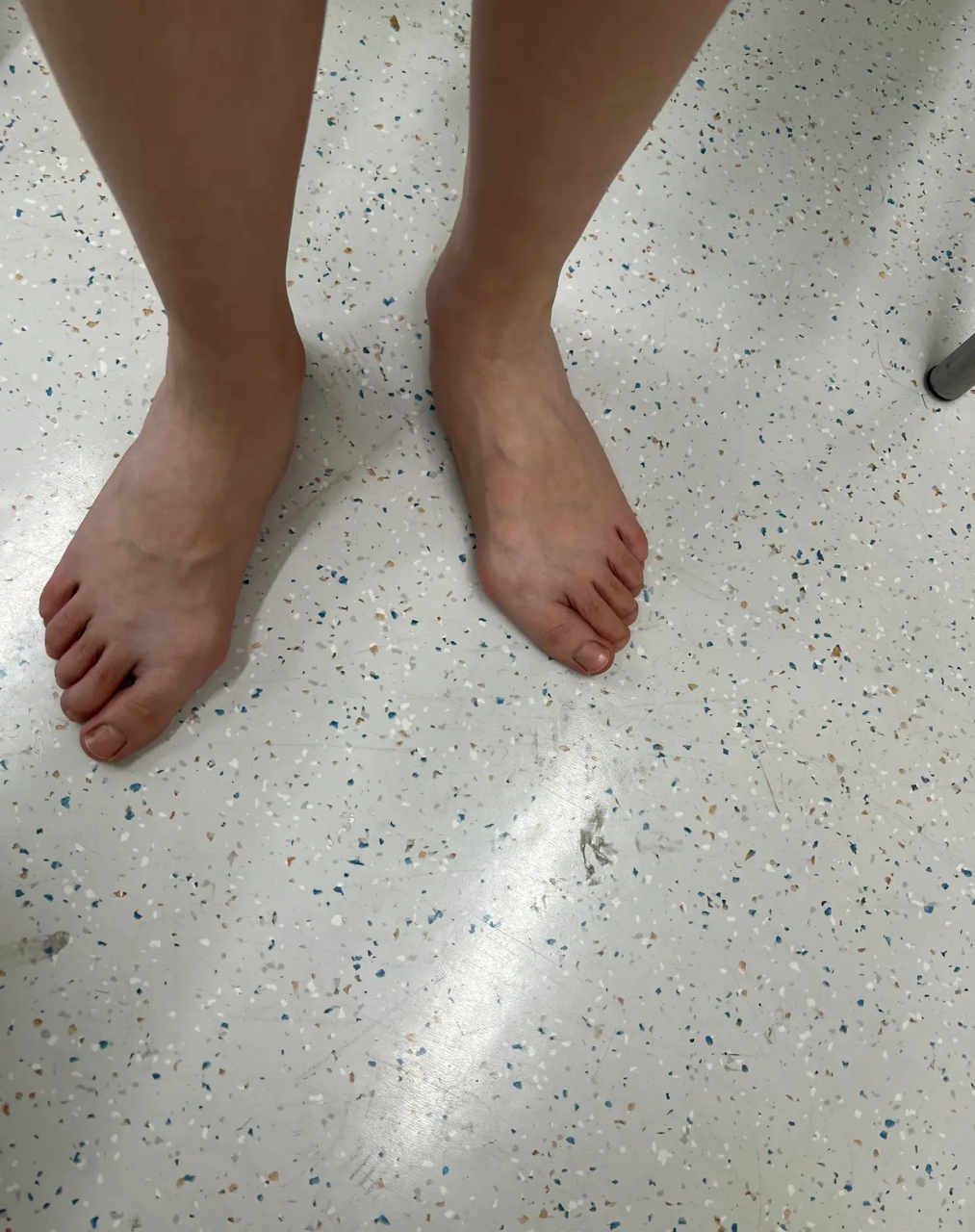 12岁女孩脚趾疼 12岁的女孩,双脚大拇趾外翻角度已经那么大,并且出现