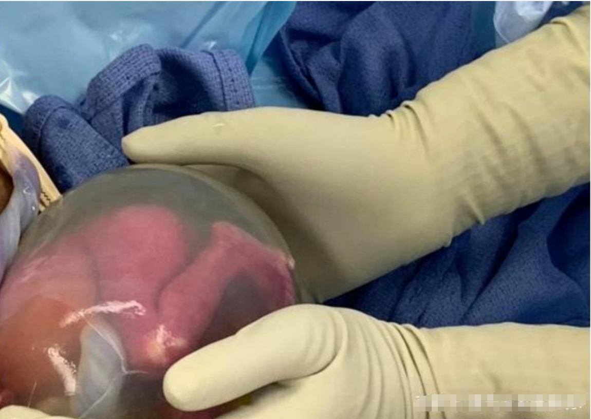 产妇生下双胞胎,一个带着羊膜,婆婆大喊丢掉,医生:无知
