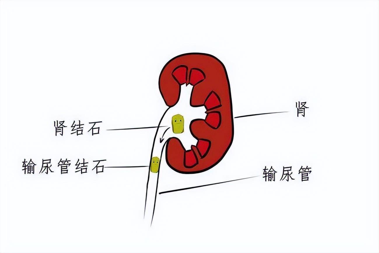 尿路结石怎么形成的图片