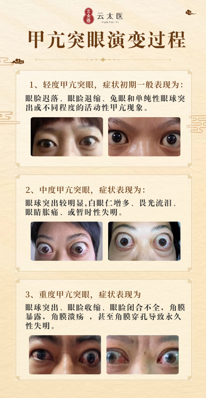 从轻度,中度,到重度每一阶段的不同表征 #突眼# #甲亢突眼
