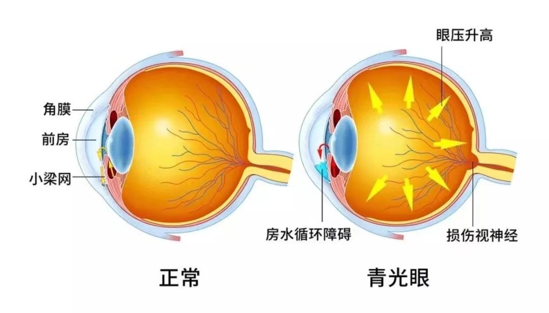 如何发现我是不是得了青光眼?