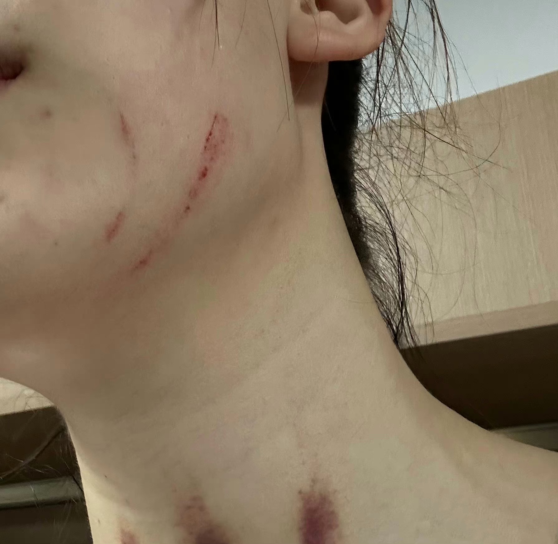 高清身上被抓伤真实照片女被挠伤的图片被挖伤的照片女生被欺负受伤