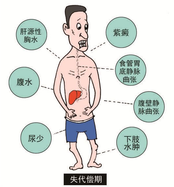 肝硬化腹水卡通图片