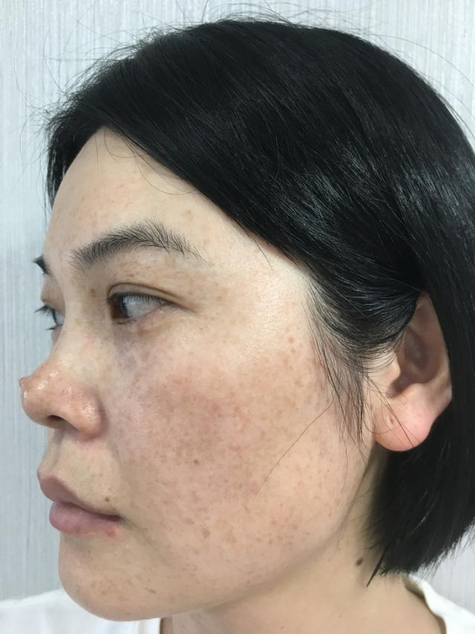 黑斑人群占比大概在10%  4.晒斑人群占比大概在9%  5.