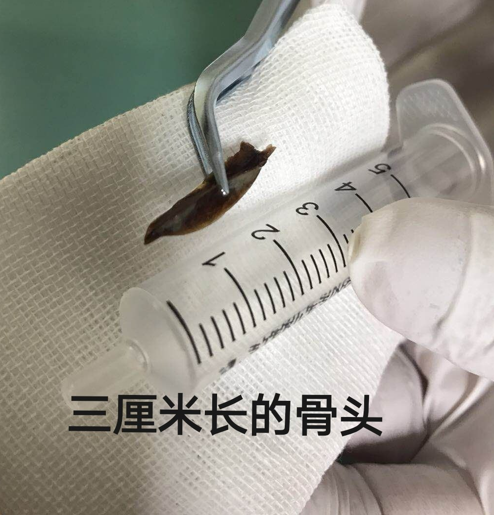 女子反复咳嗽,咳痰14年,元凶竟是肺里有一块骨头!