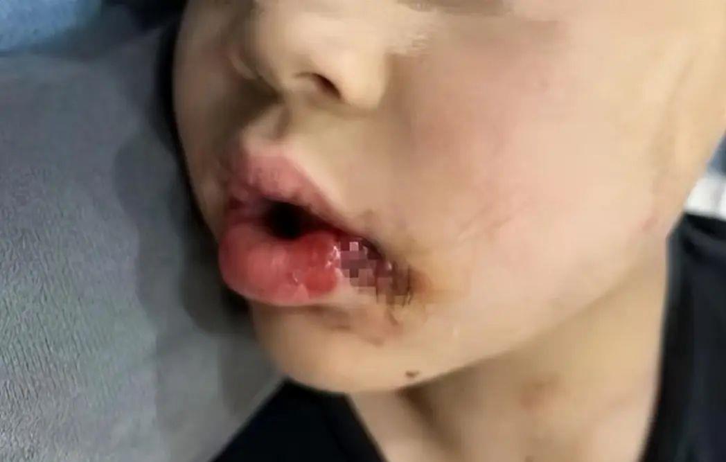 男童嘴角撕裂,牙根断裂!同伴家长如此回复