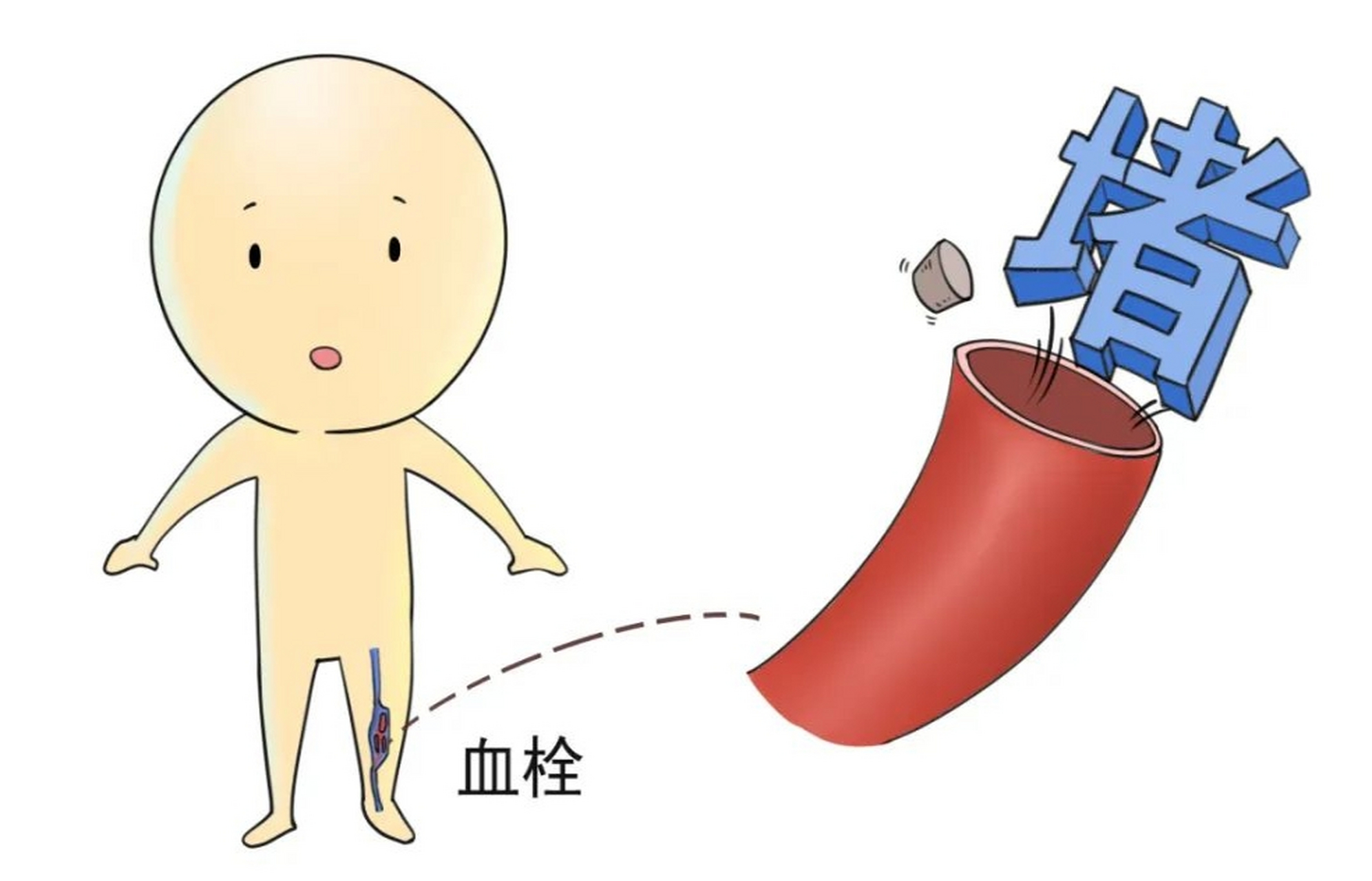 99你有没有被血栓"盯上"?