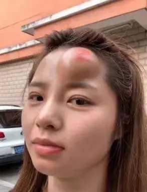 一觉睡醒,头上莫名其妙长了一个大包,大包中间还有一块红的,关键是我