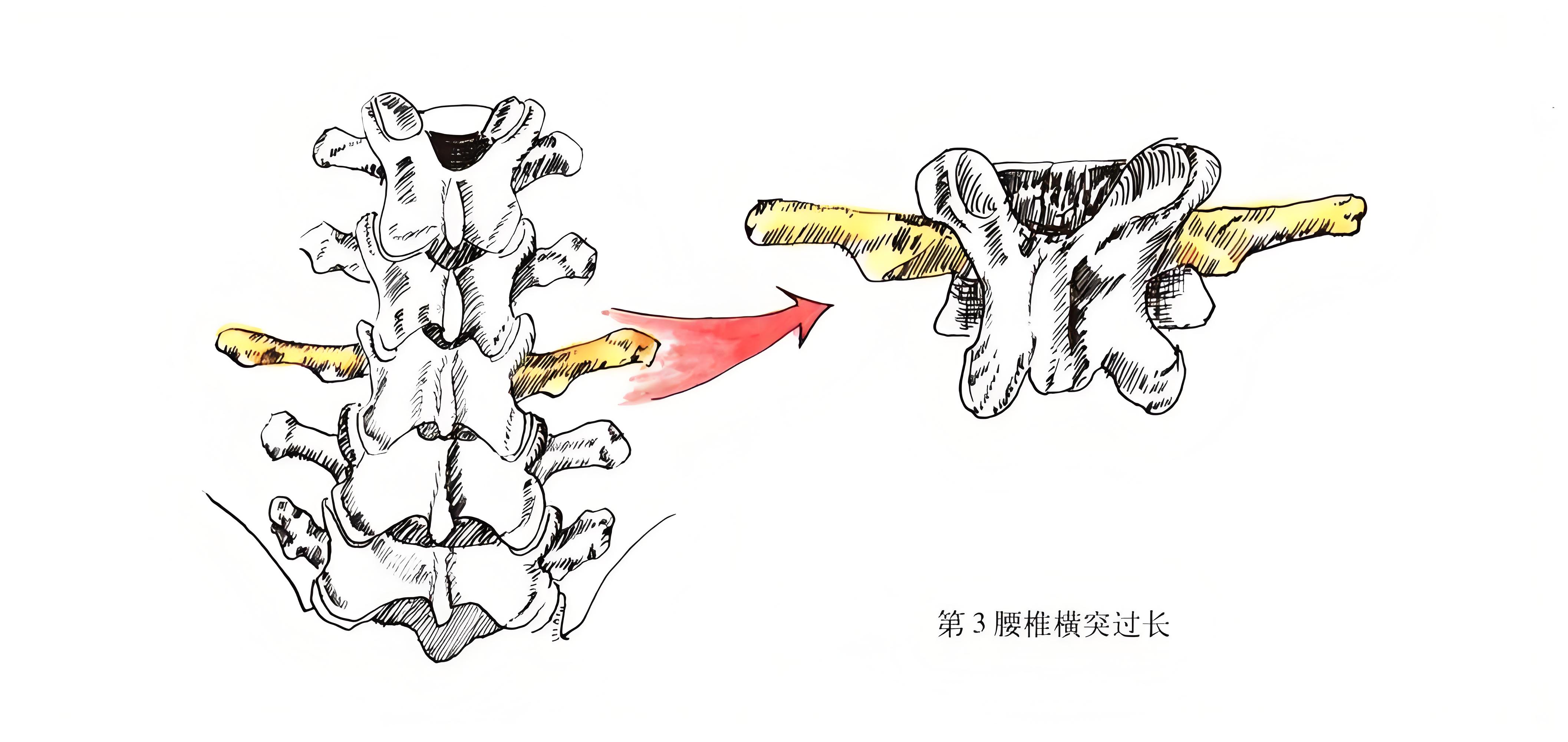 关于腰三横突综合征的预防