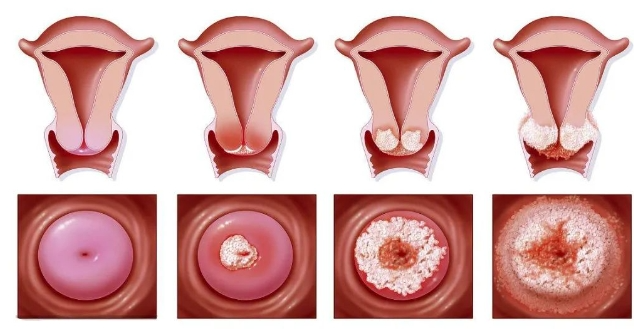 妇科炎症有哪几类?常见症状一览,帮您初步自我判断!
