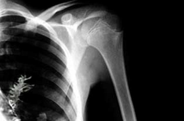 x线 x光 x光片 x线 626_412