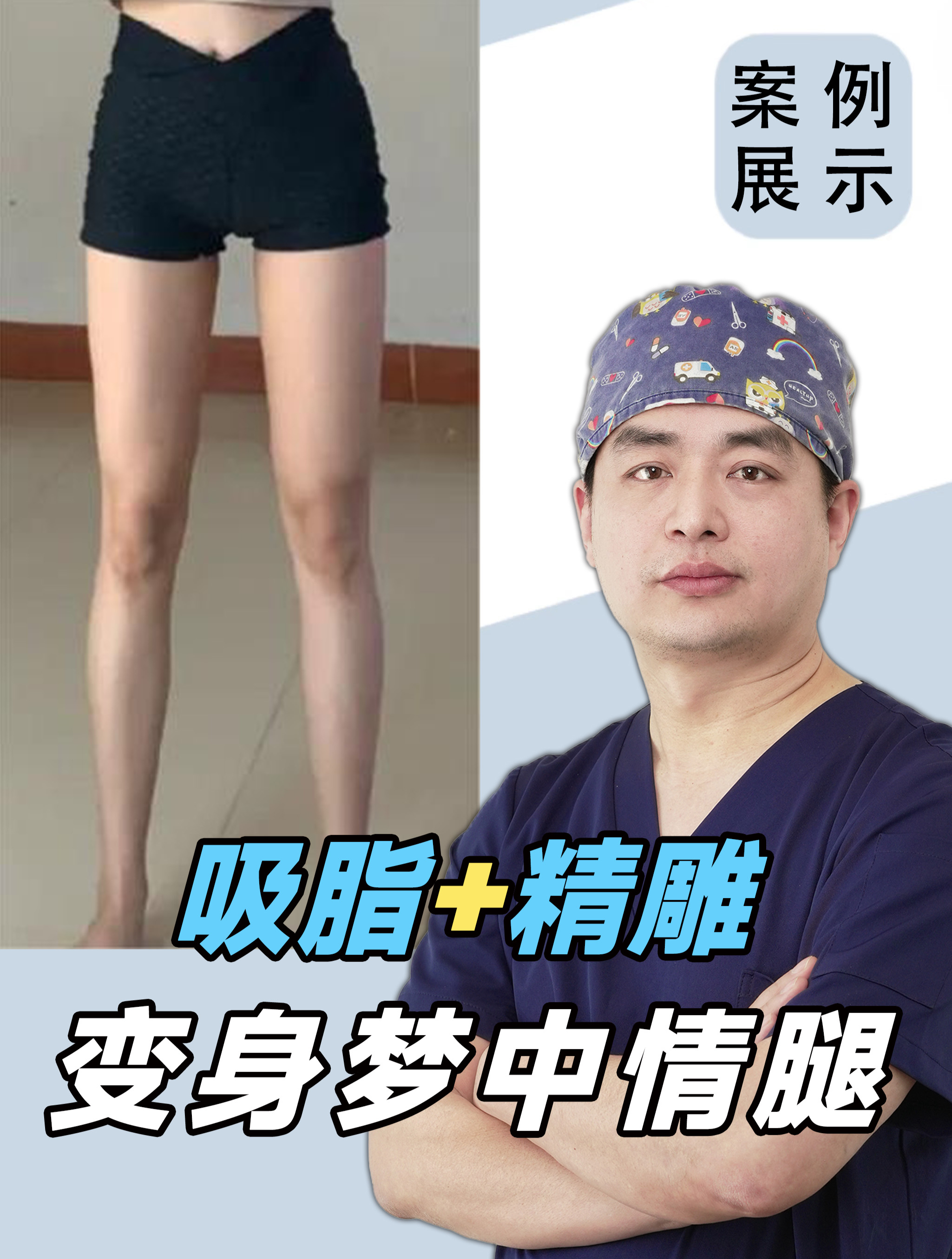 吸脂效果怎么样?2小时腿部吸脂 精雕,姑娘拥有了梦中情腿!