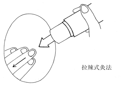 雷火灸图片 手法图片