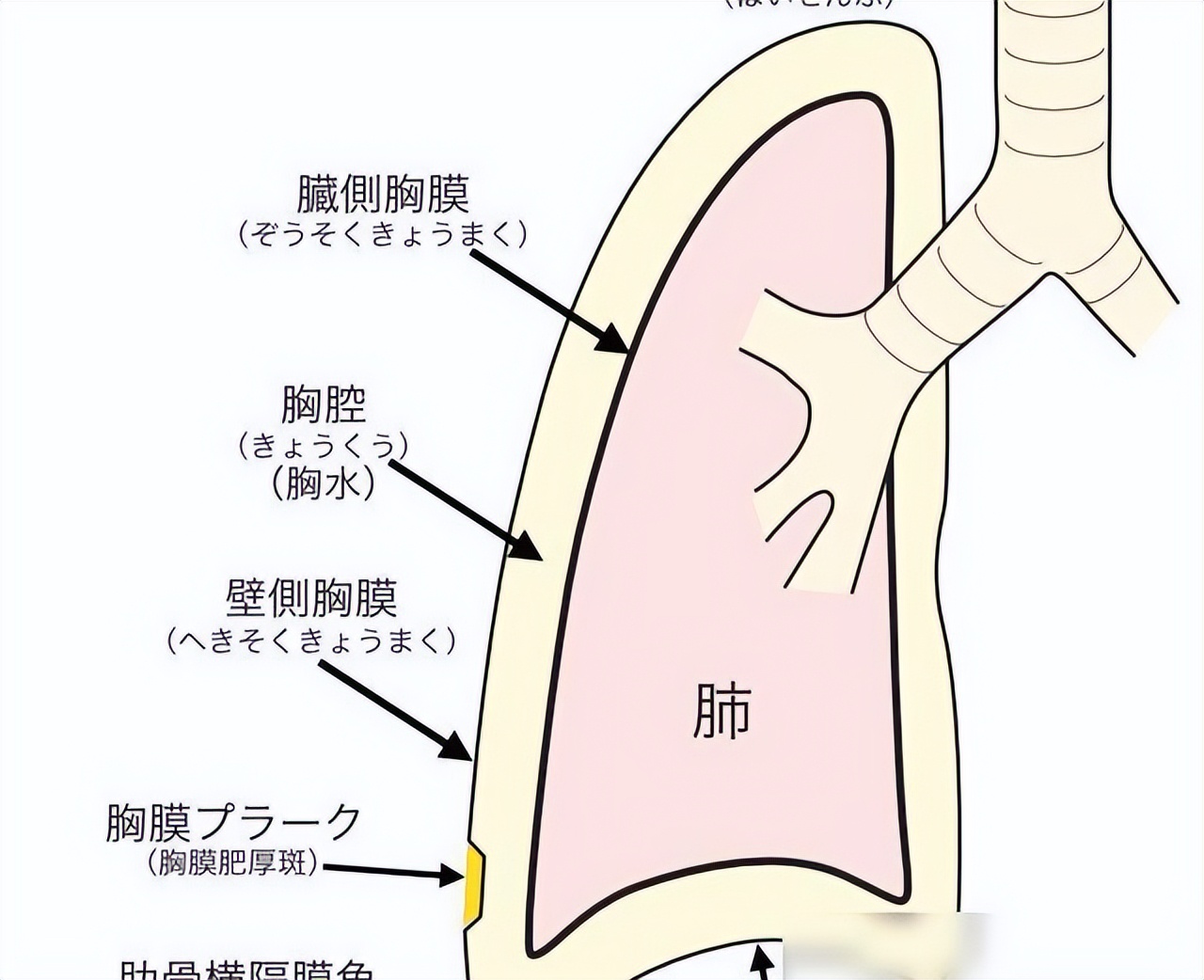 胸膜增厚图片