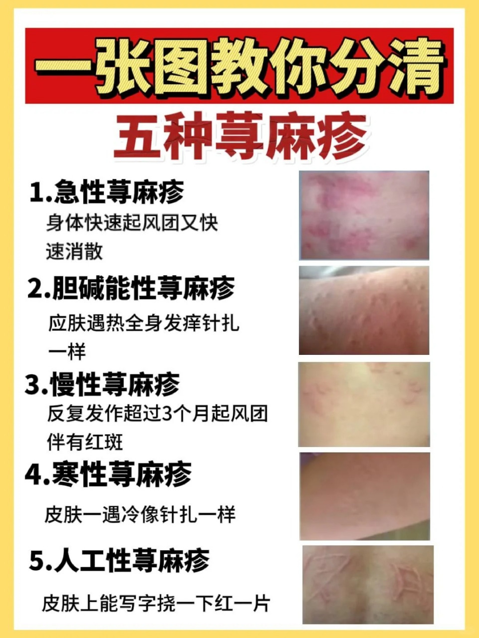 如何判断荨麻疹7515一张图搞定73 不会还有人分不清自己的荨