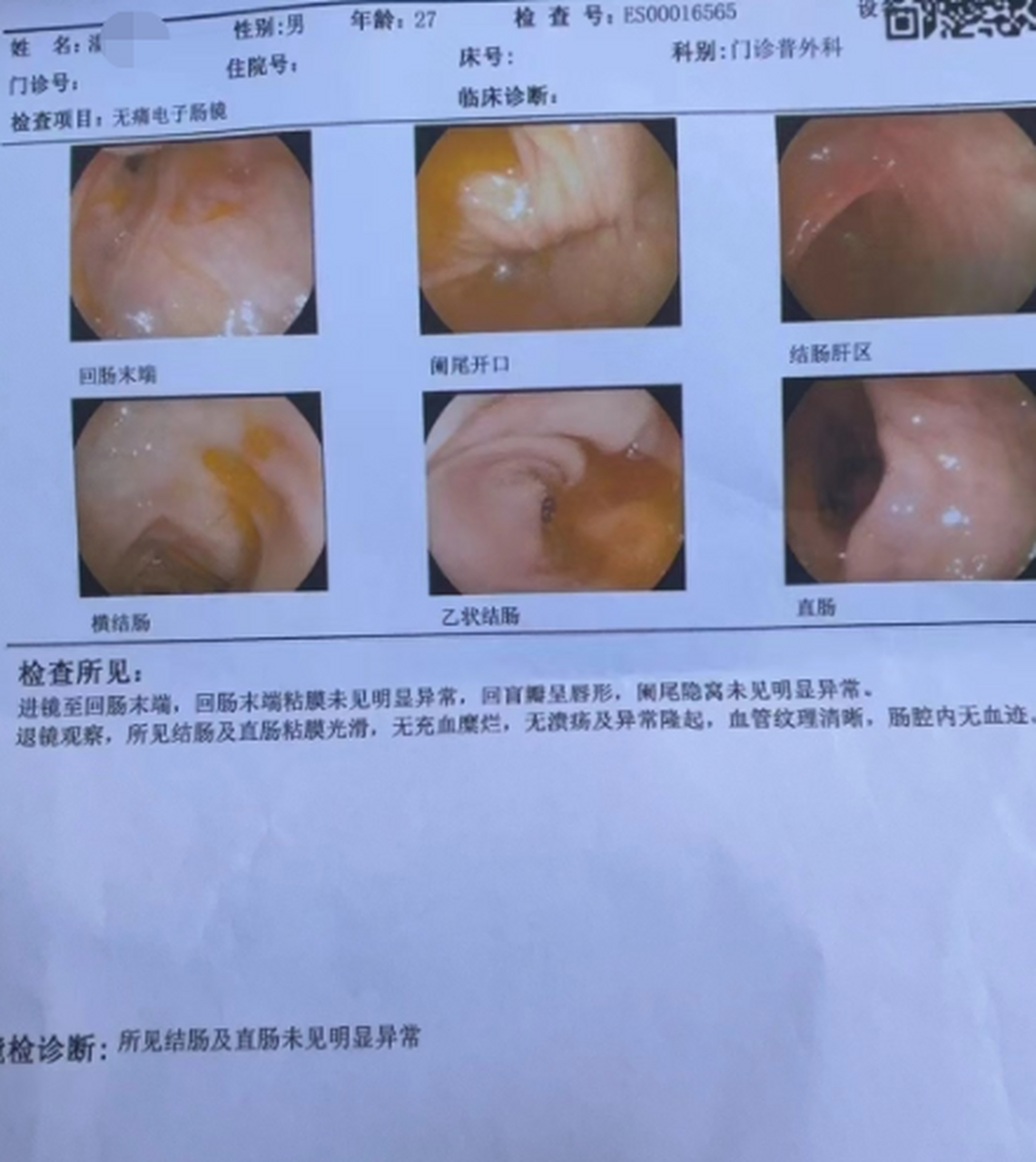 27岁的潘先生,上周发来复查的肠镜,一切都正常了,太为他高兴了!