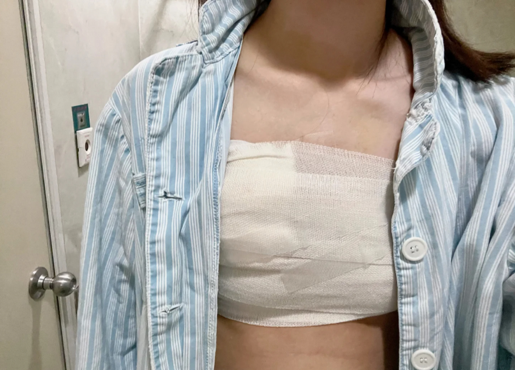 今天面诊了一位胸部过大,下垂严重的需要缩胸的求美者.