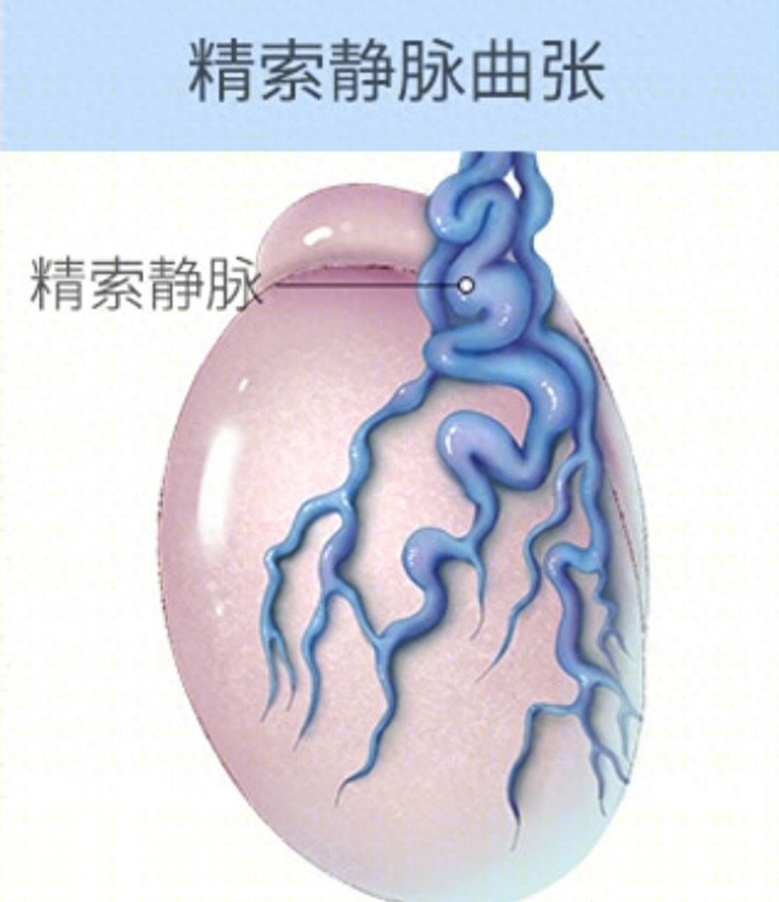 精索静脉曲张在开始的几年可能没有什么症状.
