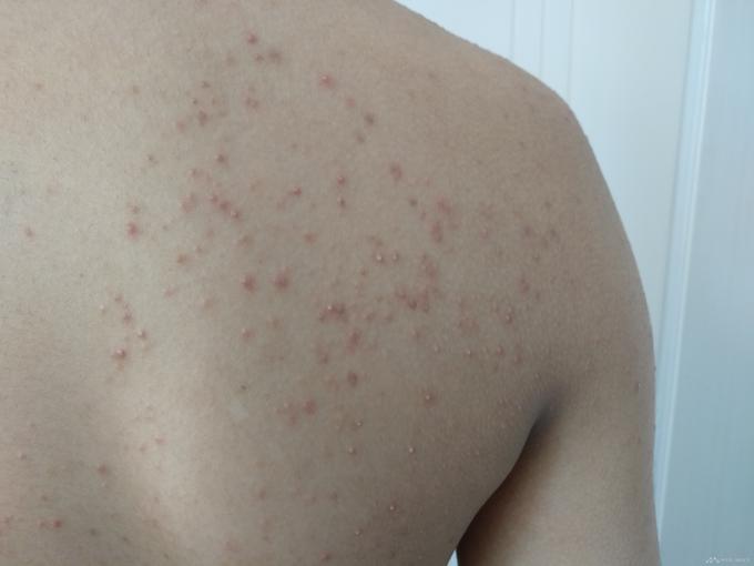 后背毛囊炎瘙痒难忍怎么治疗?上海华山医院杜荣昌医生为你解答!