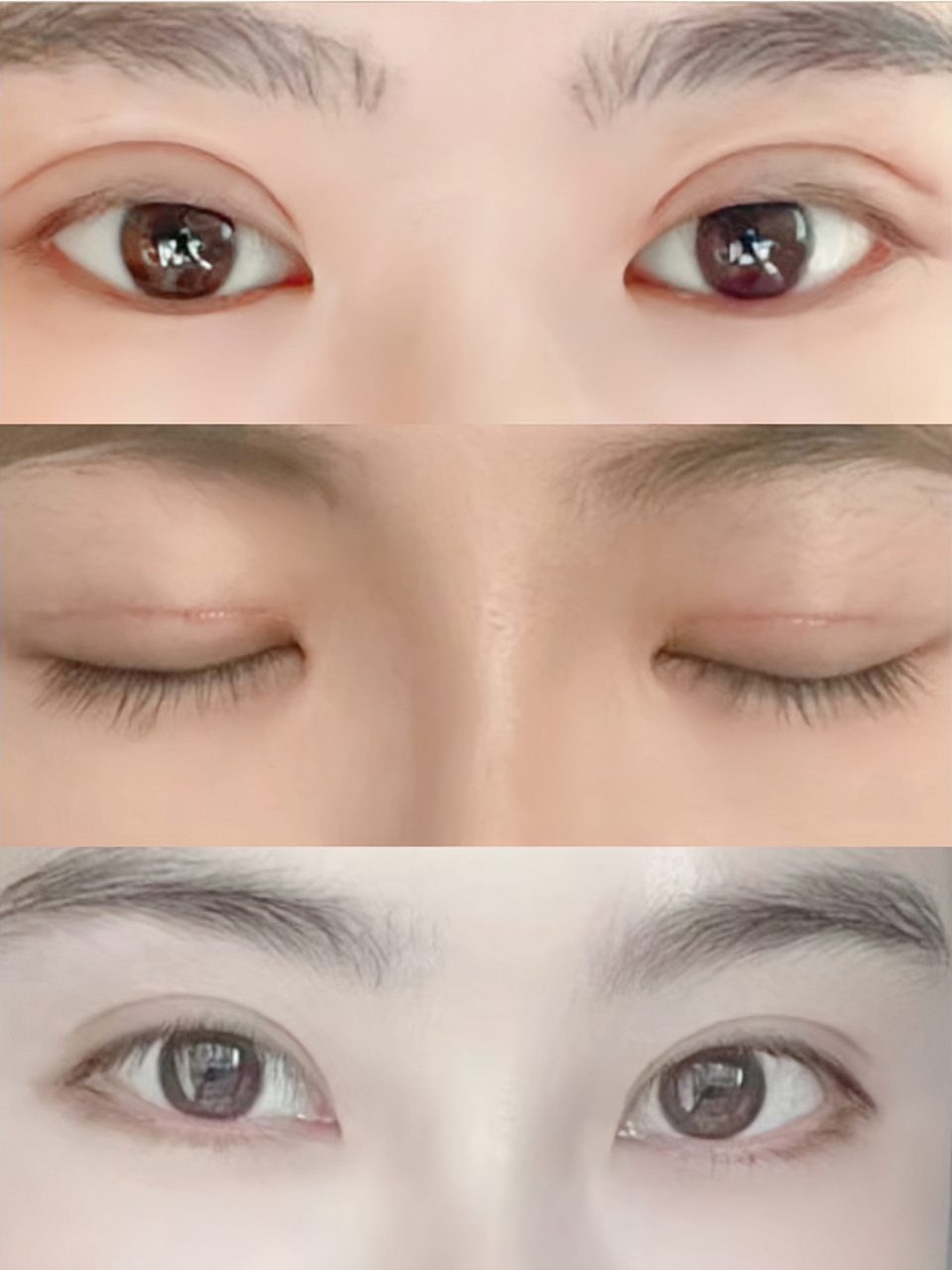 该求美者术前双眼皮接近10mm,特别臃肿,肉条感明显,而且瞳仁暴露率